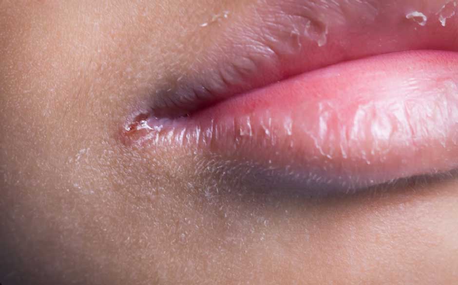 What Is Vitamin B6 Deficiency